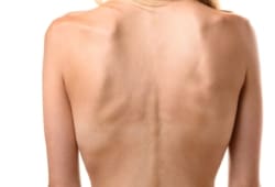 Rear view of the back of a thin woman showing ribs and spine