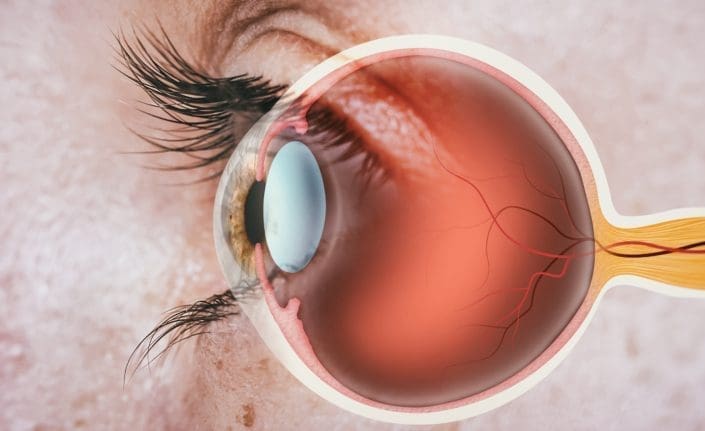 Woman nearly loses sight in one eye after wearing contacts in shower and  pool