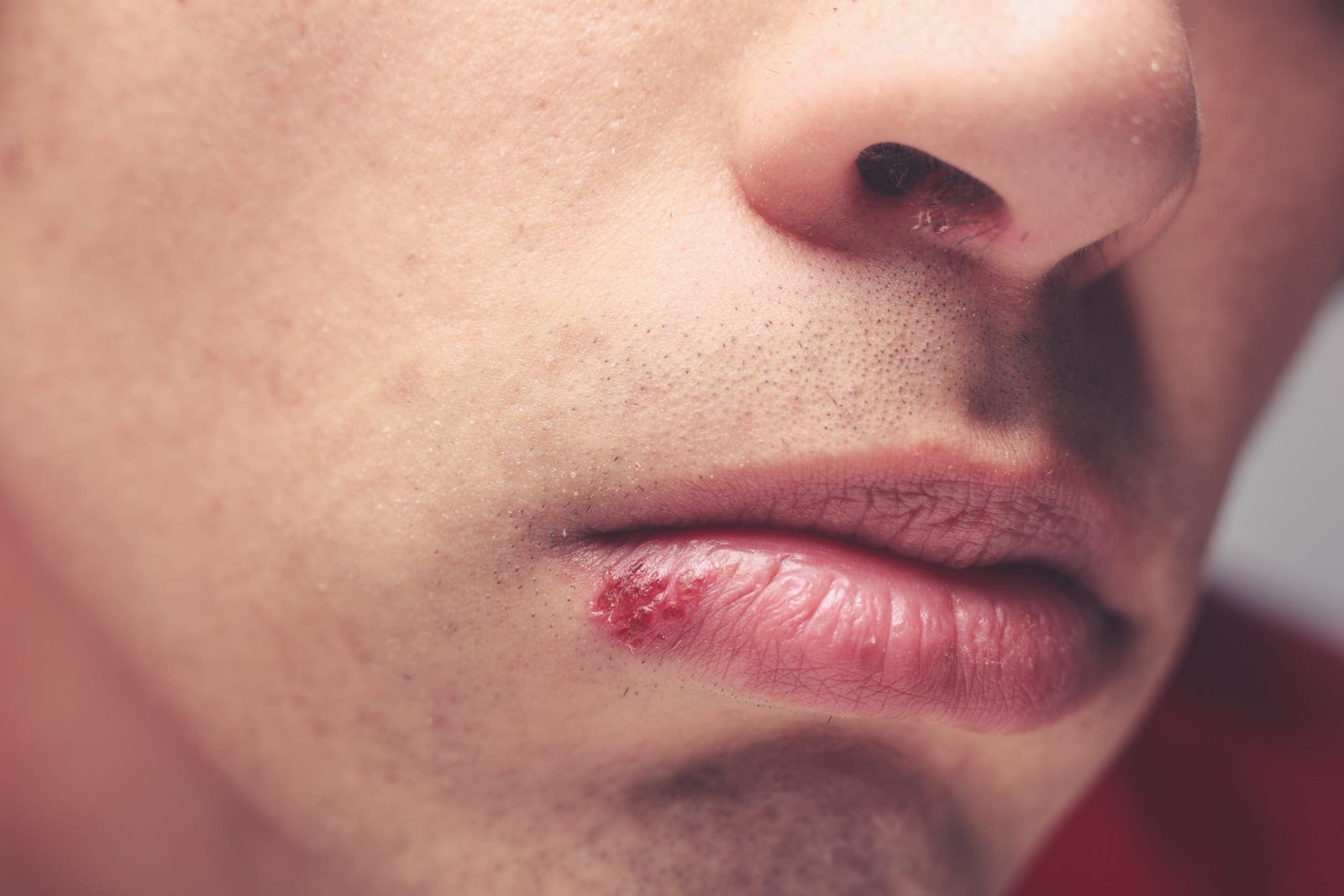 cold sores or acne