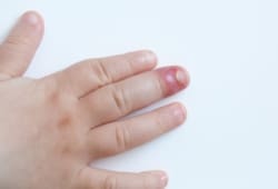 A child’s hand with red and swollen skin around fingernail caused by a skin infection. Paronychia is a skin infection around the nails. It usually affects the skin at the base (cuticle) or up the sides of the nail.