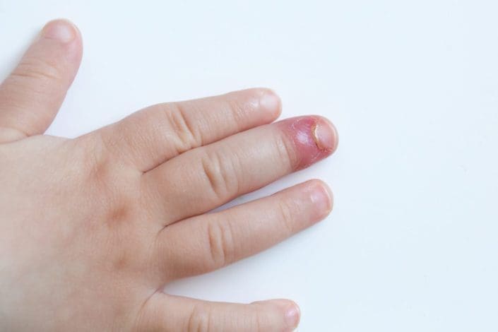 A child’s hand with red and swollen skin around fingernail caused by a skin infection. Paronychia is a skin infection around the nails. It usually affects the skin at the base (cuticle) or up the sides of the nail.