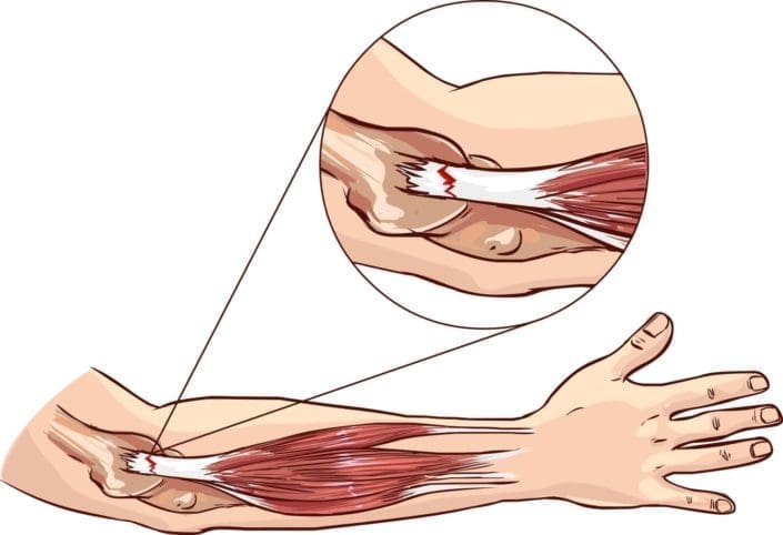 Tennis elbow - tear in the common extensor tendon of the arm