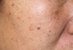 close-up of a person’s cheek with small patches of melasma