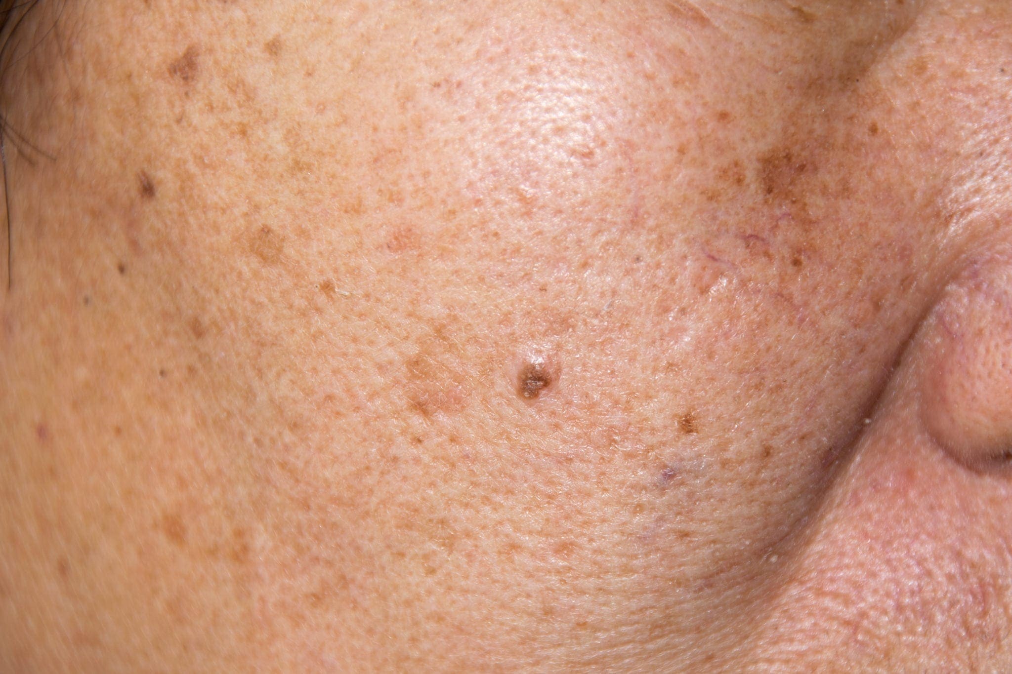 black bumps on skin