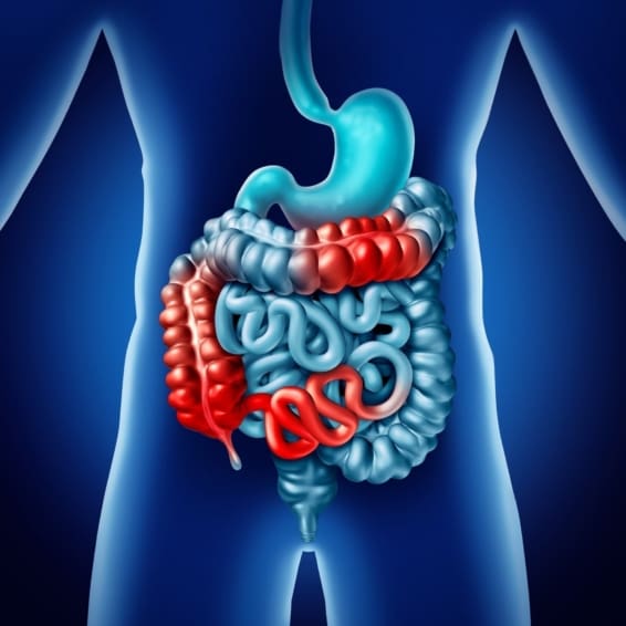 Crohns Disease and Colitis What to Know