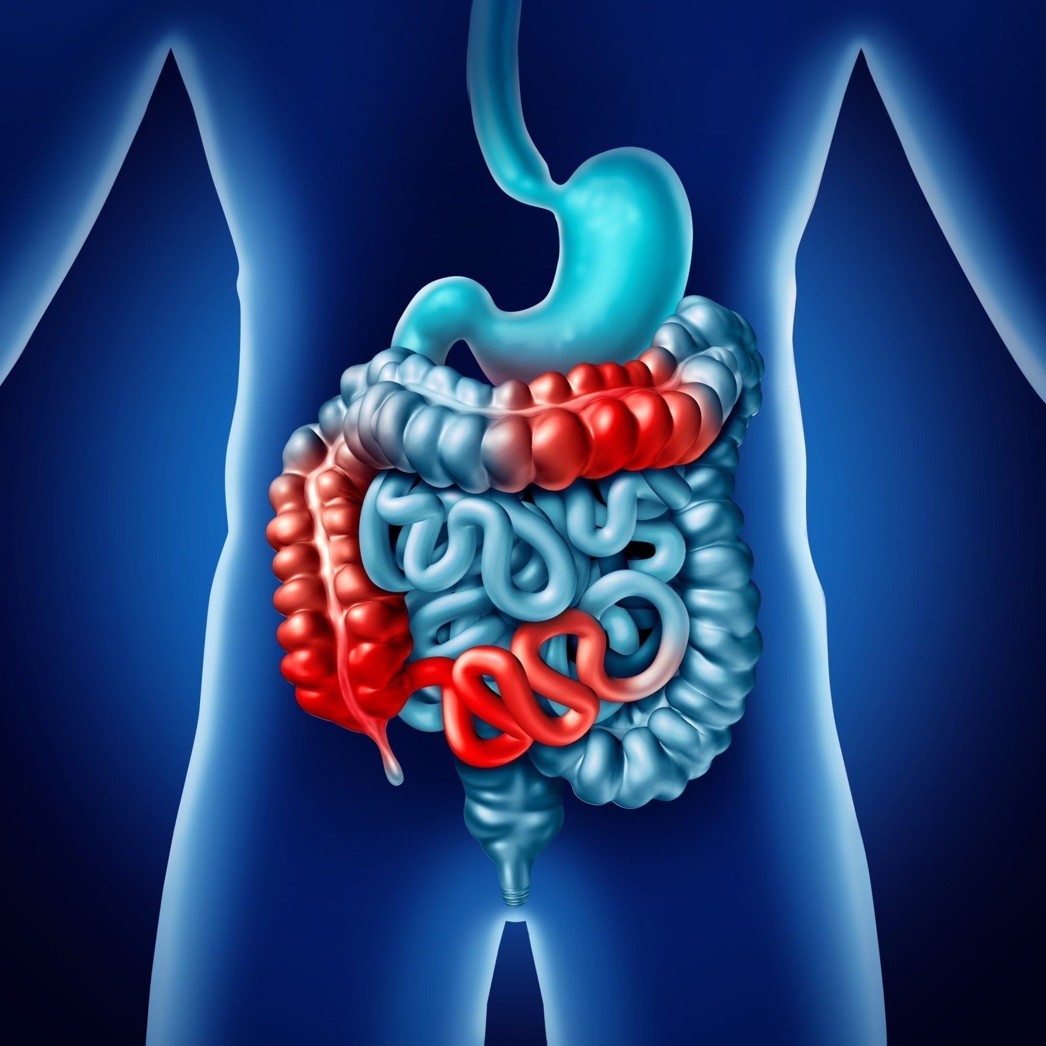 can crohn's disease be caused by diet