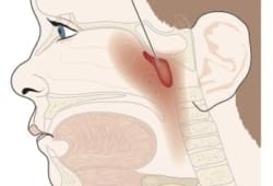 Illustration of enlarged adenoid. Adenoids are tiny pieces of tissue in the back of your throat. They hang above your tonsils. They help fight infections in your body.