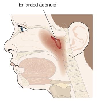 enlarged adenoid