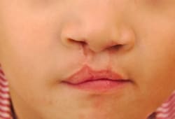 Close up of a child's cleft lip