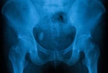 X-ray of woman’s pelvis, showing bladder stones