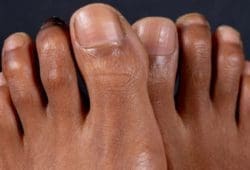 Hammer toe causes the toe to get stuck in a stiff, claw-like position over time. This can be painful and make walking difficult.