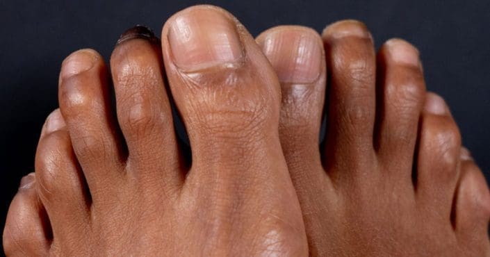 hammer-toe-prevention-and-treatment-familydoctor