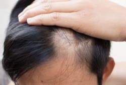 Person pushes hair back to reveal a bald spot. Alopecia areata is a form of hair loss. It’s a non-life-threatening disease of your immune system that affects the hair on your scalp.