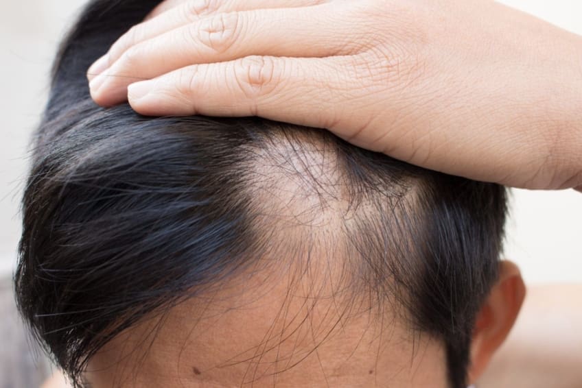 Person pushes hair back to reveal a bald spot. Alopecia areata is a form of hair loss. It’s a non-life-threatening disease of your immune system that affects the hair on your scalp.