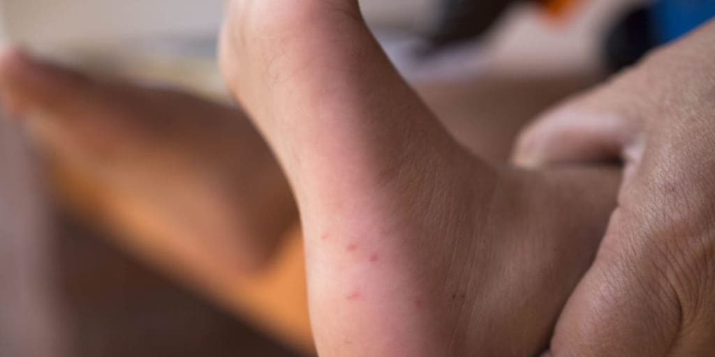 Hand, foot, and mouth disease is a common, mild, contagious childhood illness. It causes mouth sores and a rash on the hands and feet.