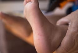 Hand, foot, and mouth disease is a common, mild, contagious childhood illness. It causes mouth sores and a rash on the hands and feet.
