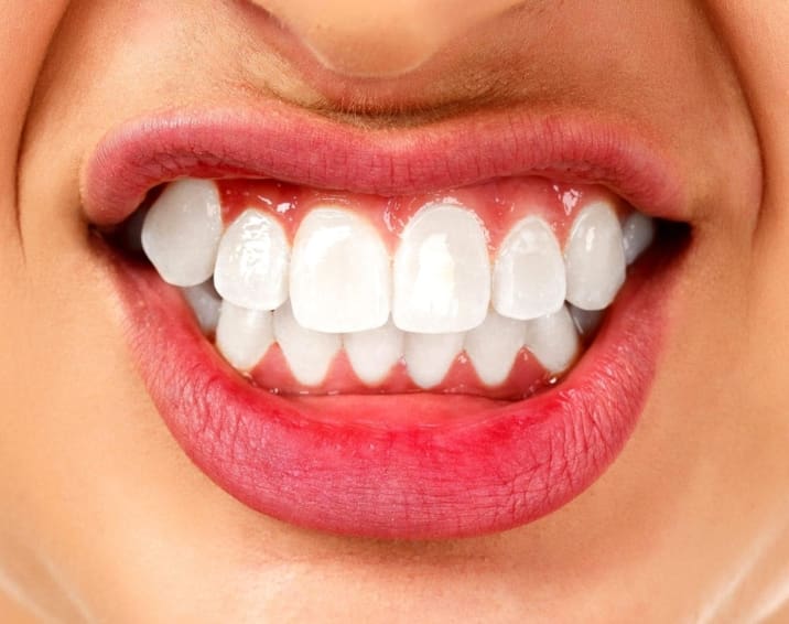 Teeth grinding is also known as bruxism. About 20% or 30% of children clench their teeth but usually stop as they get older.