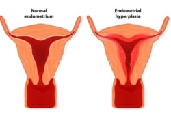 Visual difference between a normal endometrium and endometrial hyperplasia