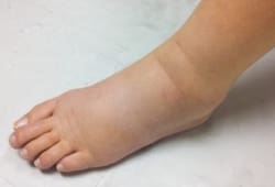 A swollen foot caused by lymphedema. Lymphedema occurs when there is excess fluid inside your body. It causes swelling in your arms, legs, fingers, and toes.