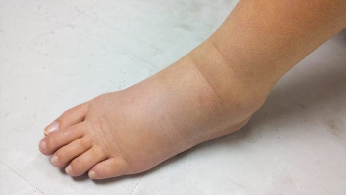 an excess buildup of fluid in the ankle causing swelling