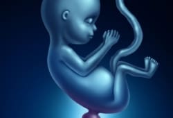 3D illustration of a fetus who has spina bifida, a neural tube defect