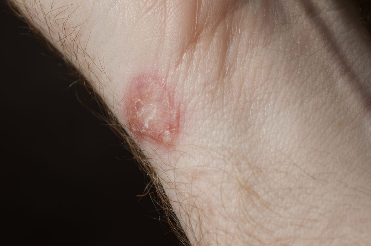 Circle rashes on the skin but not ringworm: Other causes