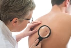Dermatologist uses magnifying glass to examine a mole on the back of a male patient