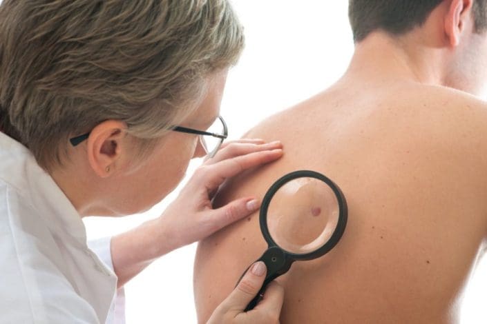 Dermatologist uses magnifying glass to examine a mole on the back of a male patient
