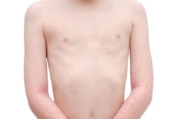 Young boy with skin rash covering his chest and arms