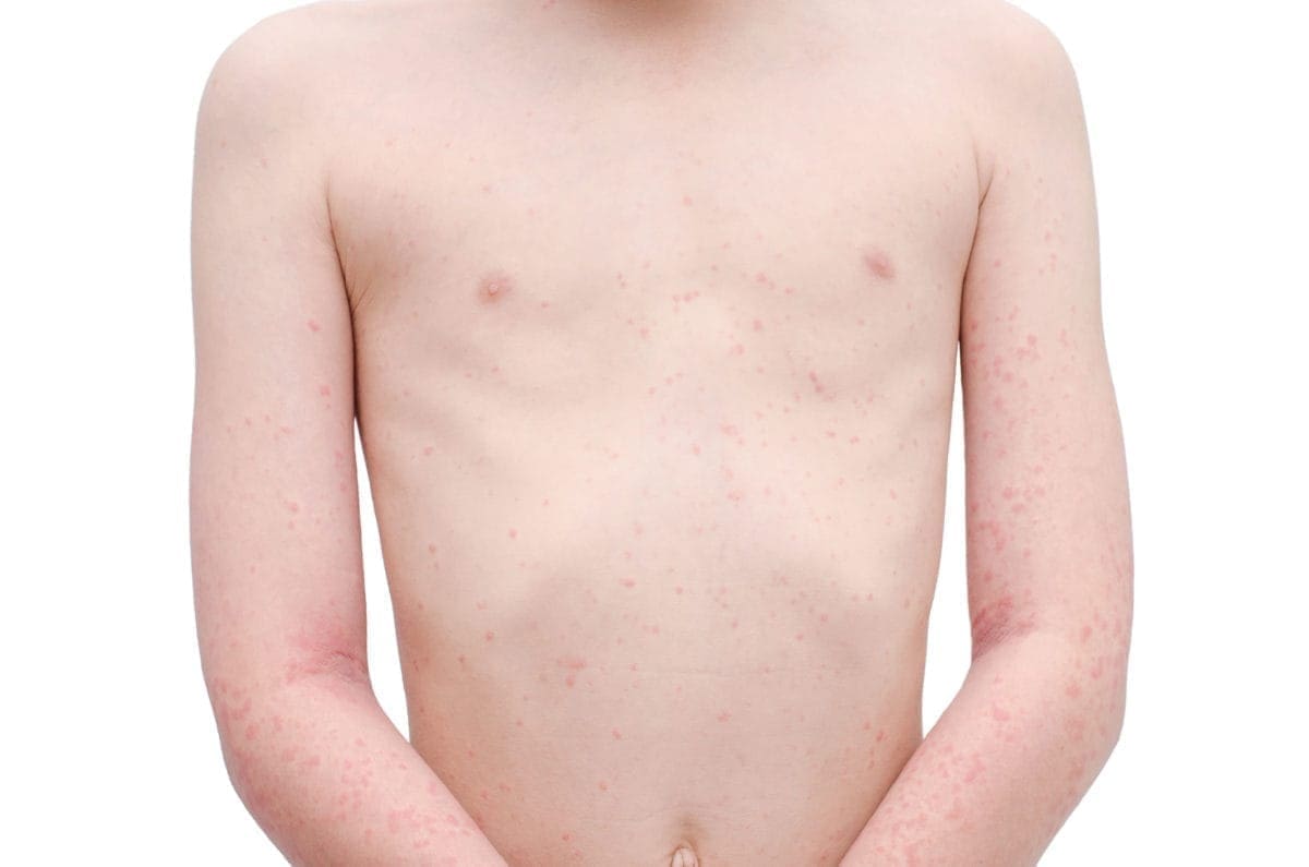 How to spot tell-tale scarlet fever rash as cases soar and 6 kids die in  Strep A outbreak