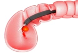 Illustration of colon polyps removal, using a colonoscope