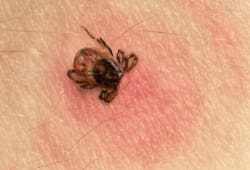Tick with its head sticking in human skin, red blotches indicate an infection