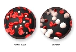 illustration of normal blood vs. leukemia