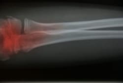 X-ray of image with red highlighting area of cancer