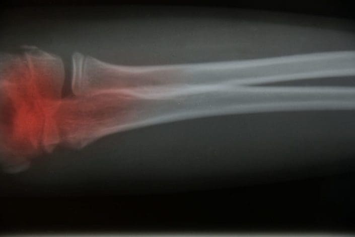 X-ray of image with red highlighting area of cancer
