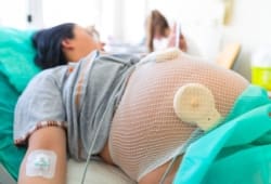 pregnant woman in the hospital with fetal heart rate monitoring sensors strapped to her abdomen