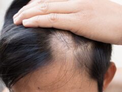 Alopecia Areata (Hair Loss)