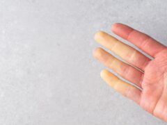 Raynaud’s Disease