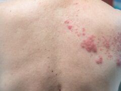 Shingles