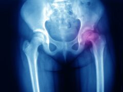 Slipped Capital Femoral Epiphysis