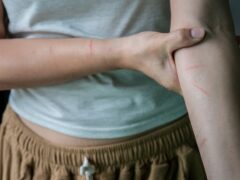 Cat-Scratch Disease (Cat-Scratch Fever)