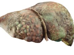 Cirrhosis and Portal Hypertension