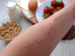 Food Allergies