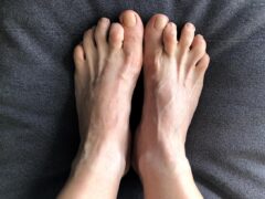 Hammer Toe
