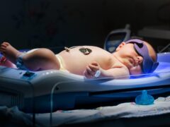 Infant Jaundice