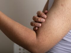 Keratosis Pilaris
