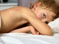Measles