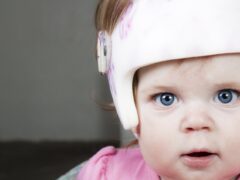 Plagiocephaly