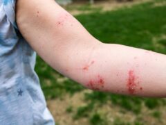 Poison Ivy Rash