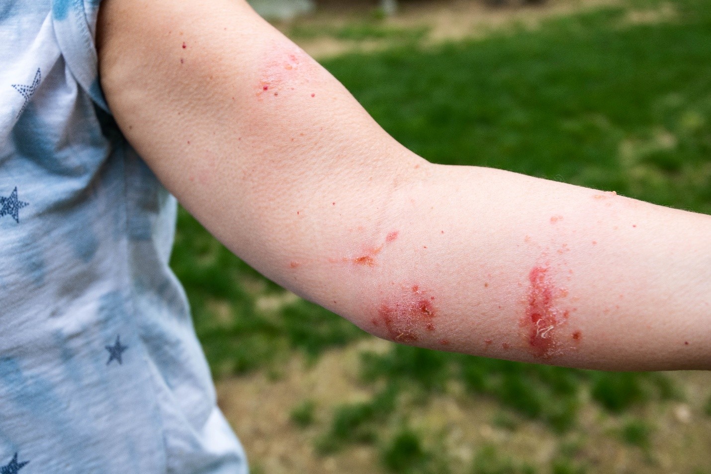 Poison Ivy Rash Family Doctor Poison Ivy Rash Family Doctor